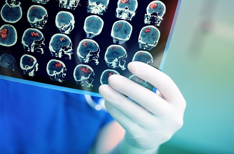 encephalitis
